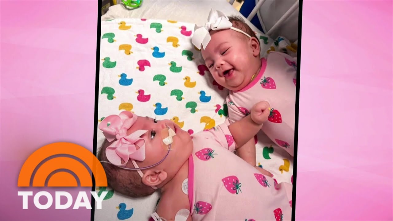 Separated Conjoined Twins Heading Home After Successful Surgery 0334